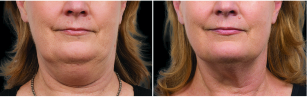 double chin before and after with coolsculpting