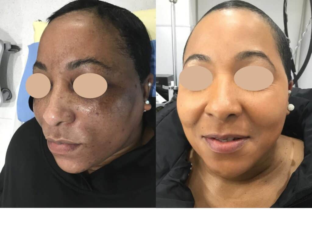 Before and after