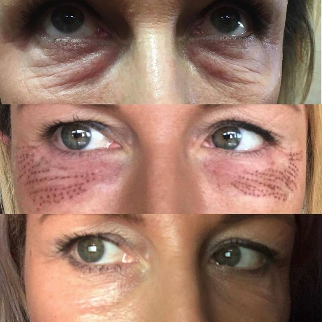 Before & Afters London Premier Laser & Skin Clinic