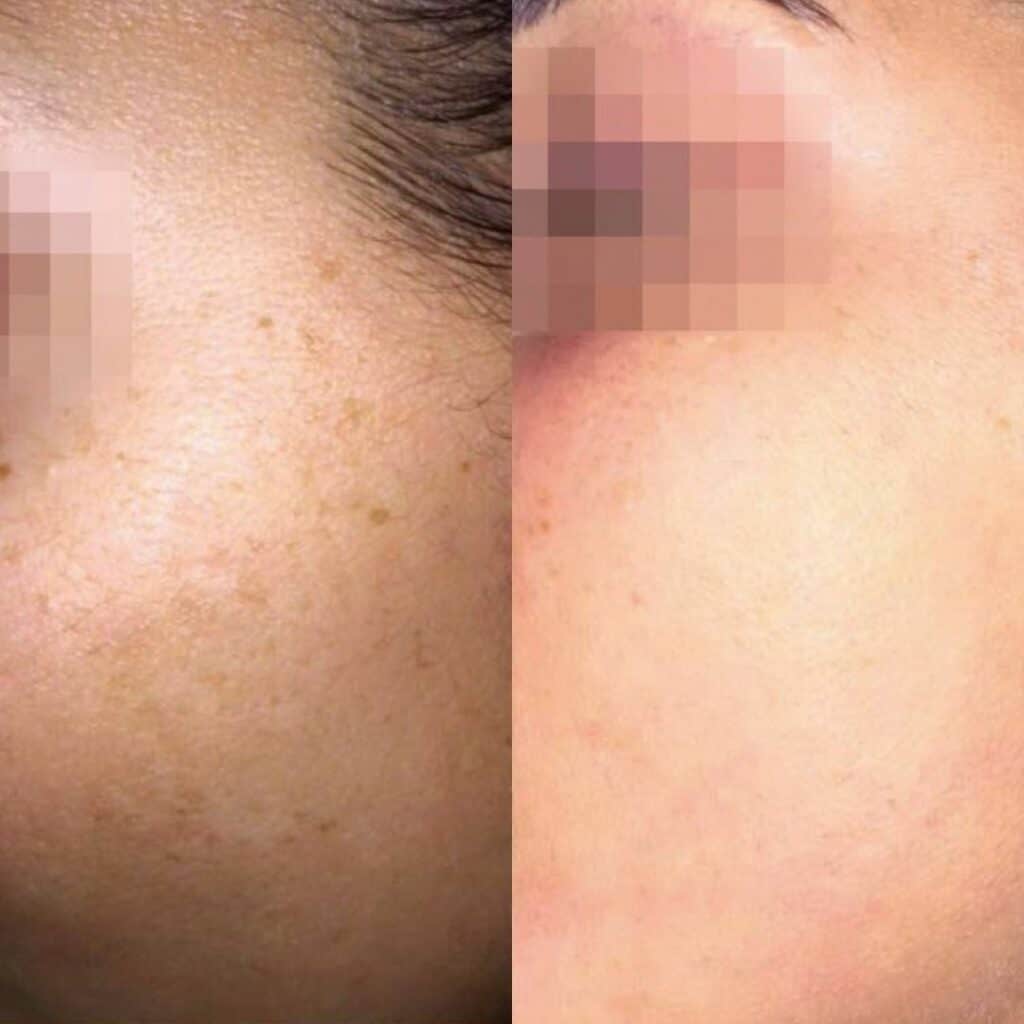 Skin Pigmentation Treatment before and after
