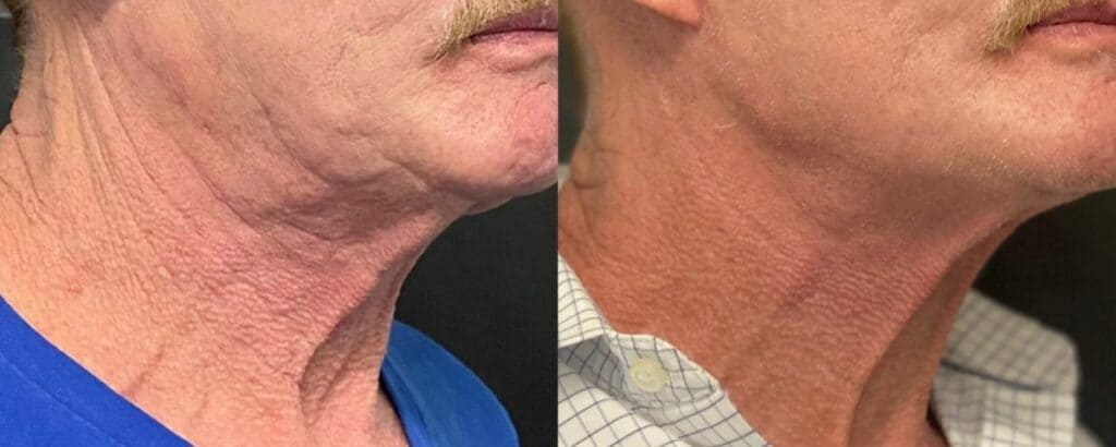 Before and after