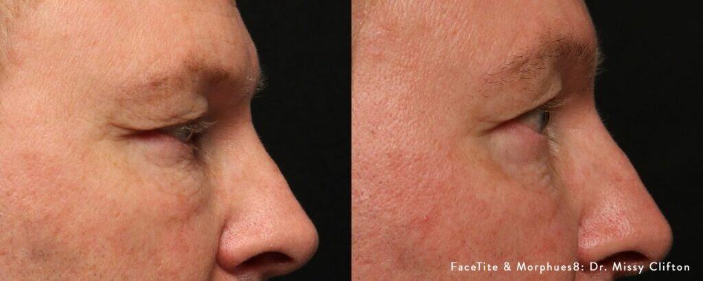 Before and after