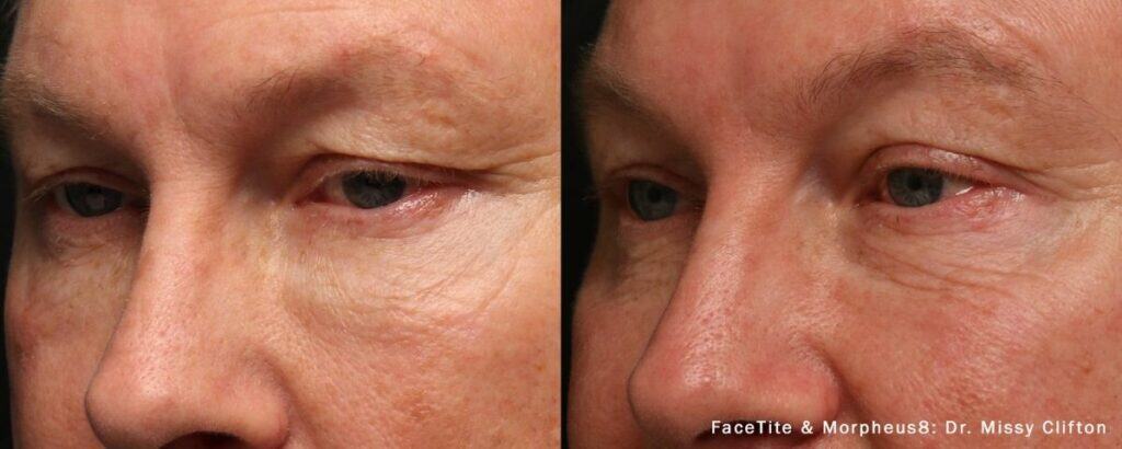 Before and after