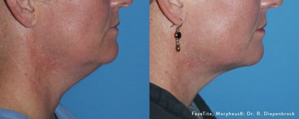 Skin Tightening Treatments before and after