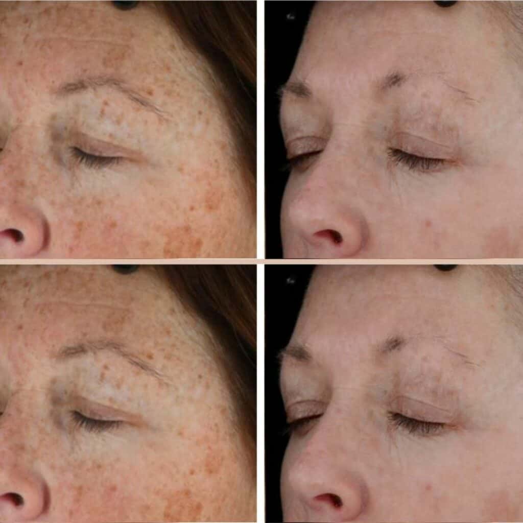 Skin Pigmentation Treatment before and after