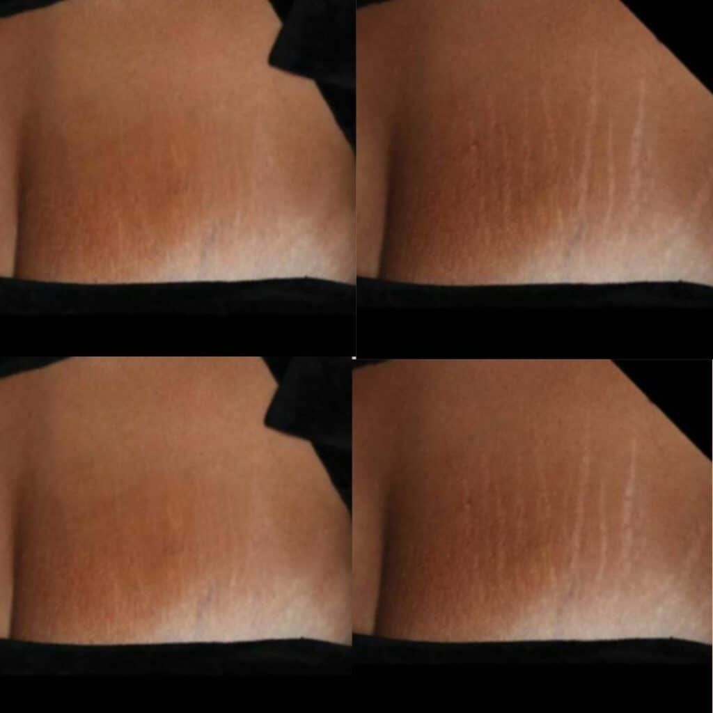 Stretch Mark Removal before and after