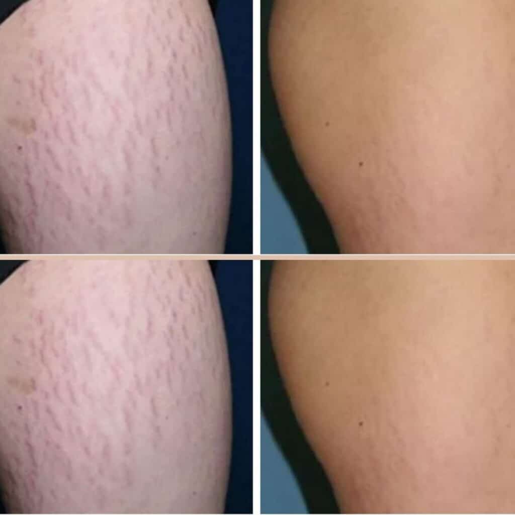 Stretch Mark Removal before and after