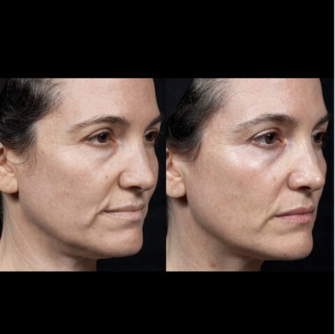 thermage before and after