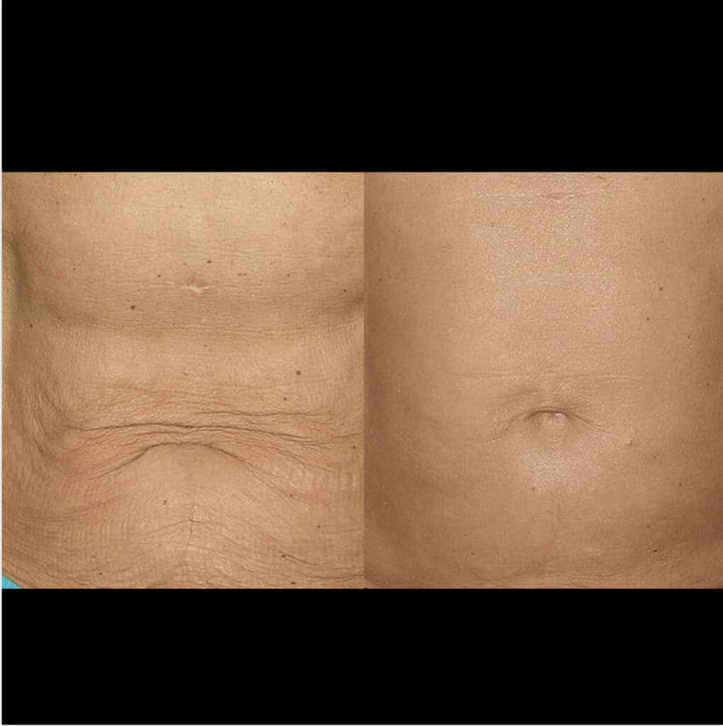 Before and after