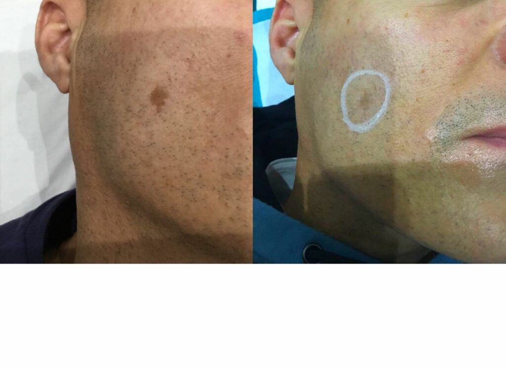 Before and after