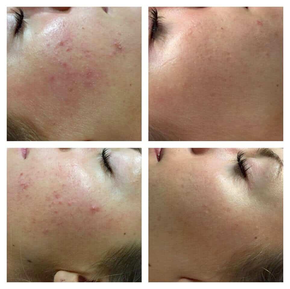 Acne before and after