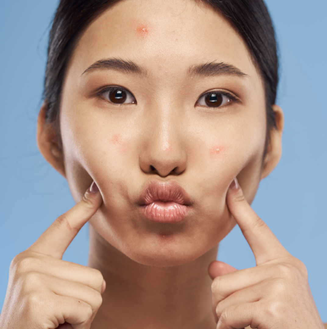 best treatments for acne