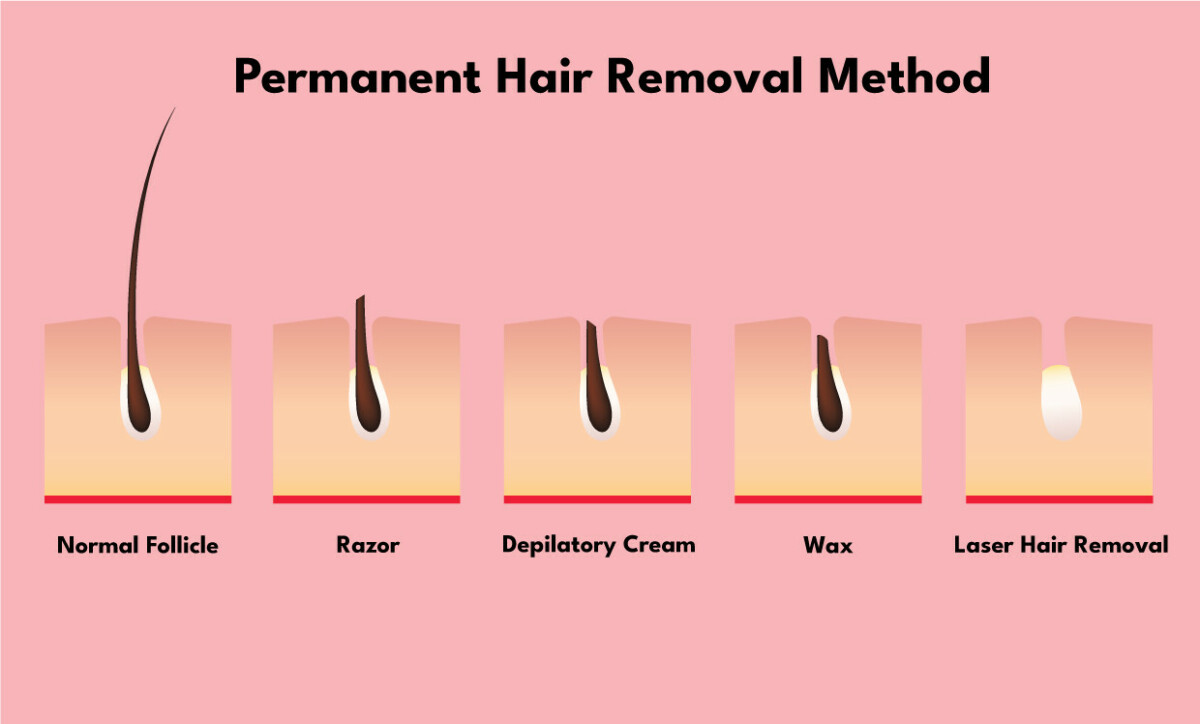 Will Permanent Hair Removal Ever Be Possible?