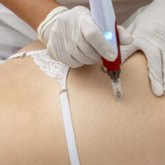 microneedling image mobile banner 2