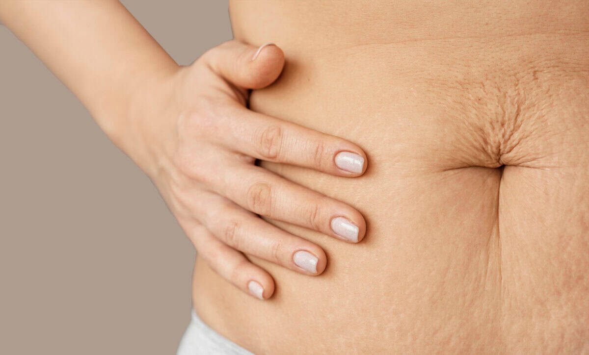 How to Get Rid of Saggy Skin After Weight Loss Injections