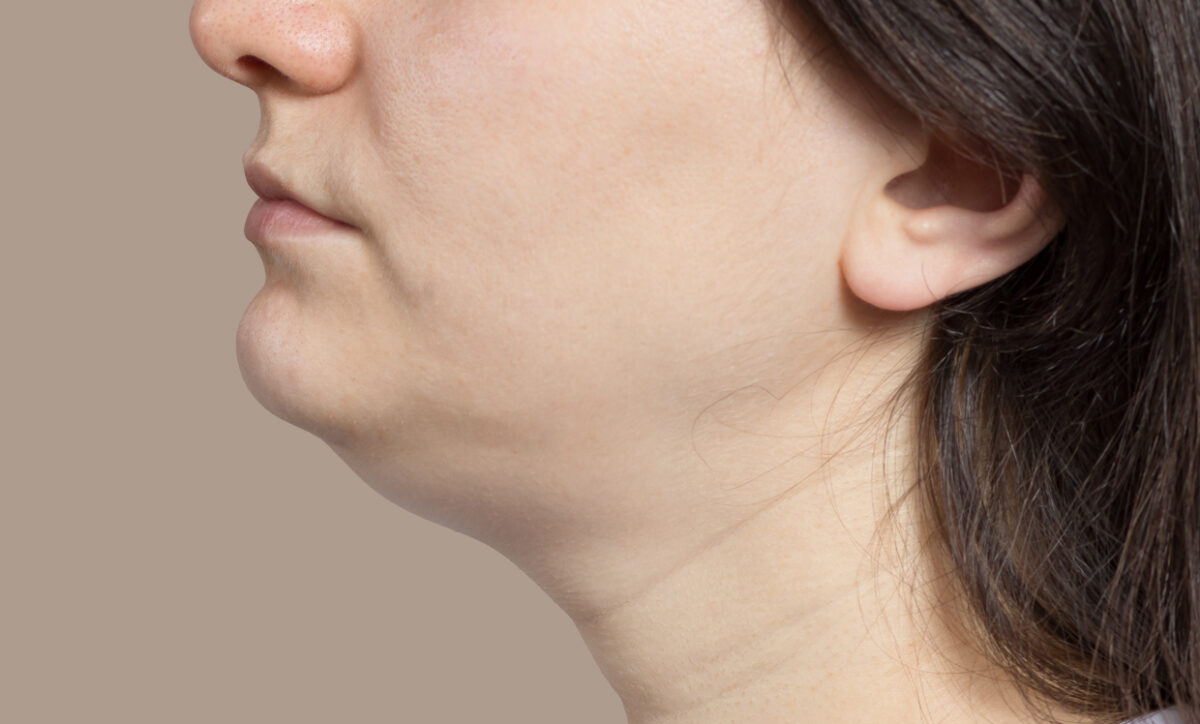 How Long Does CoolSculpting Last on a Double Chin?