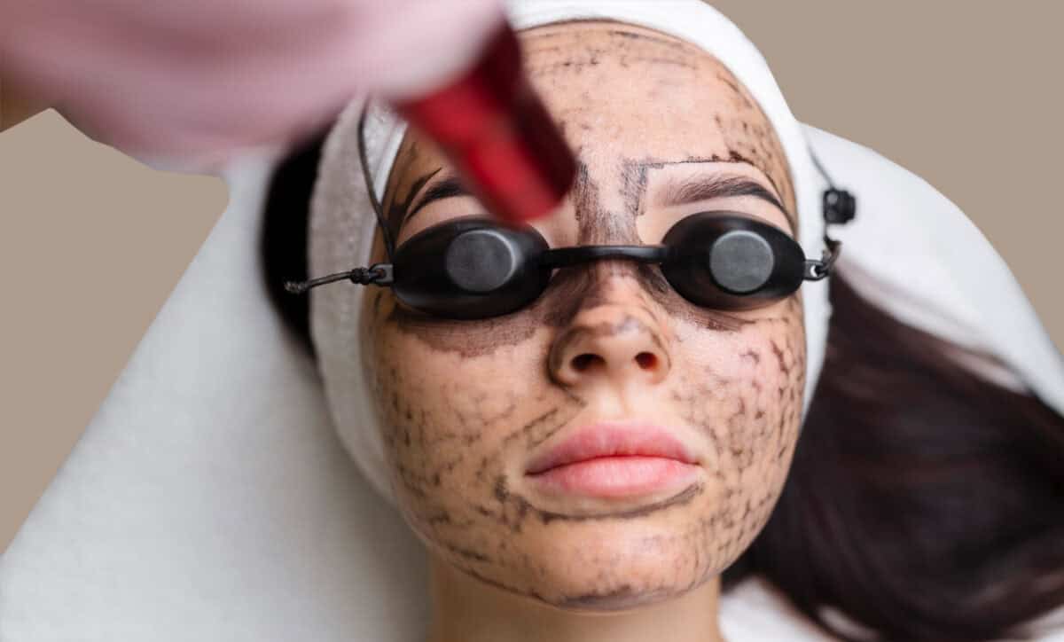 Is Carbon Facial Better Than Microneedling?