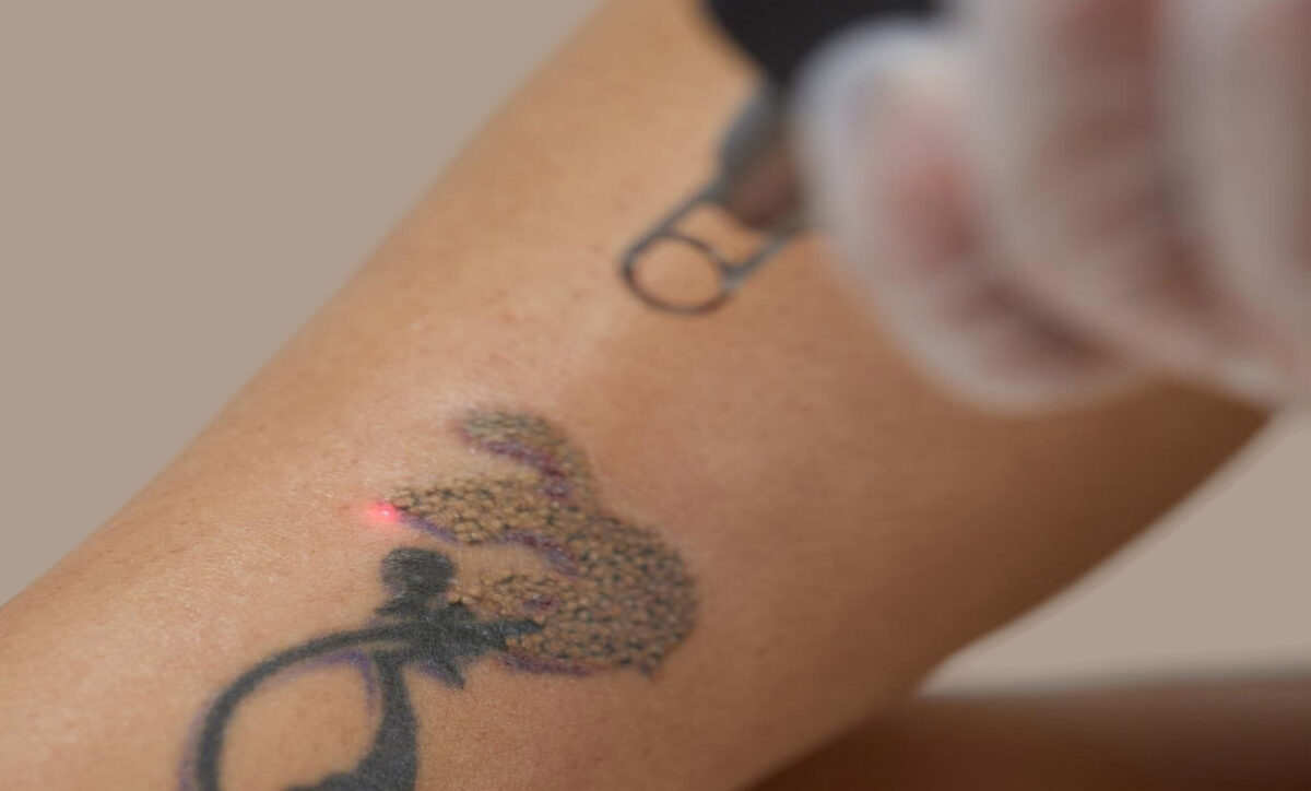 What is the age limit for laser tattoo removal?