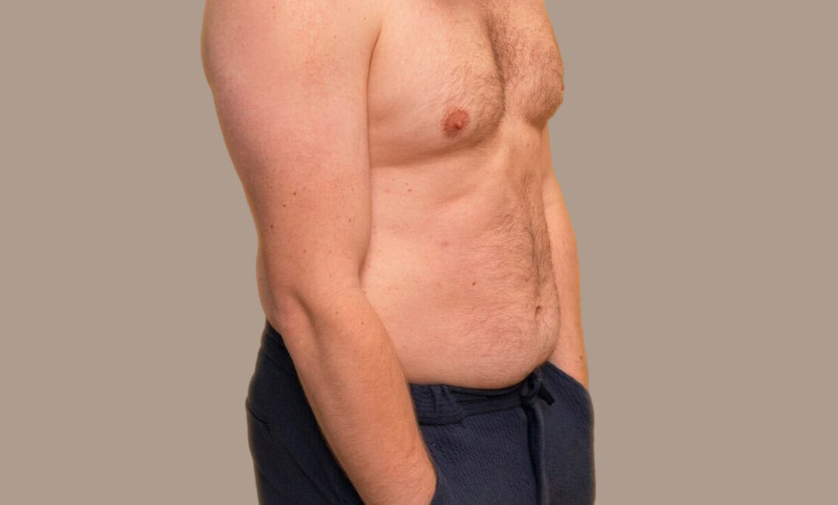 What Is the Best Procedure for Hanging Belly?