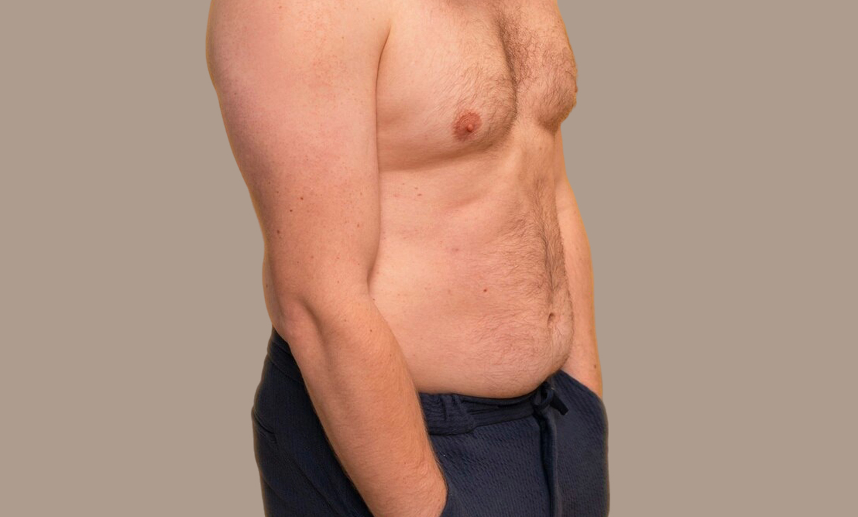 What Is the Best Procedure for Hanging Belly?