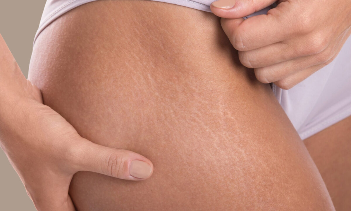 Why Am I Full of Stretch Marks?
