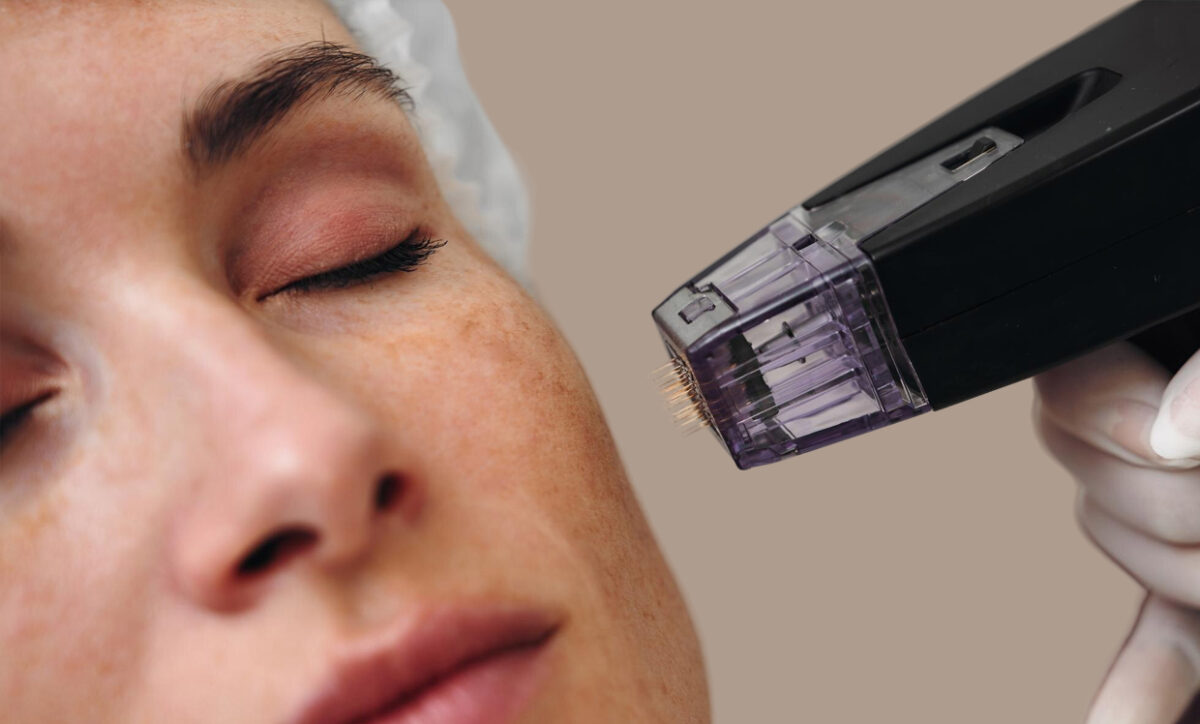 How Long Does Morpheus8 Last?