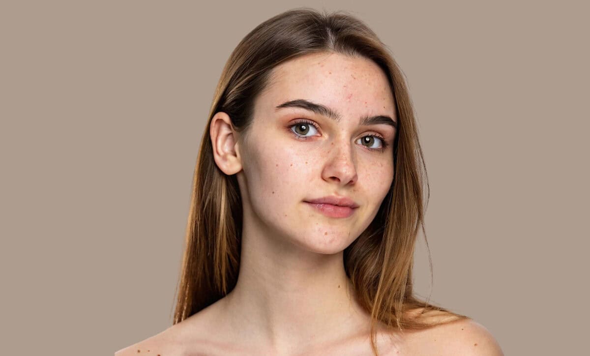 Will Laser Hair Removal Work on PCOS?