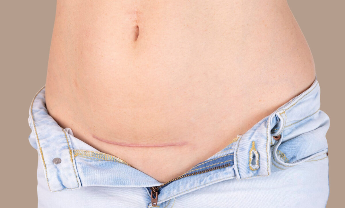 Top Treatments to Fade Surgical Scars