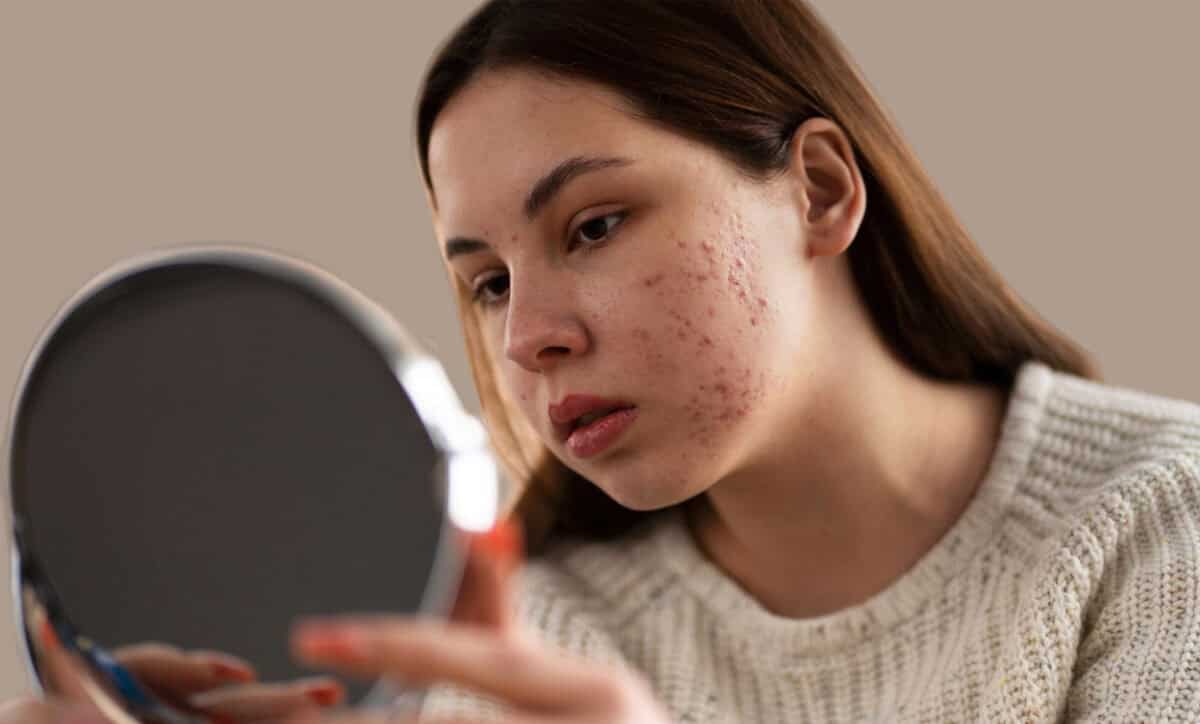 When Is It Too Late to Treat Acne Scars?