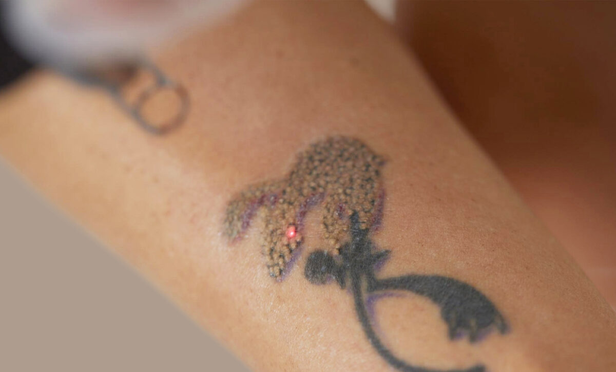 Why Are Gen Z Regretting Tattoos?