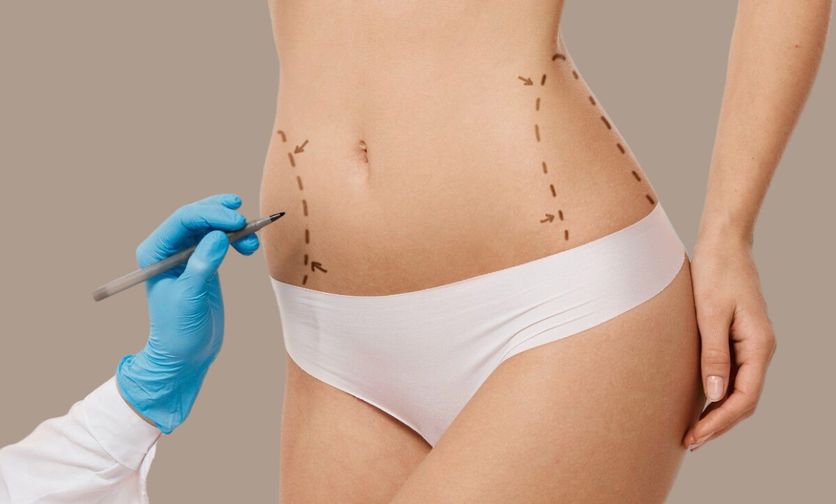 How Many CoolSculpting Sessions Do You Really Need?