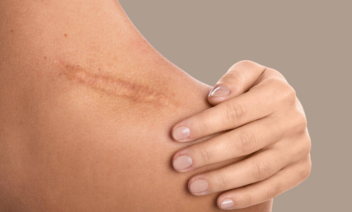 How to Get Surgical Scars to Fade