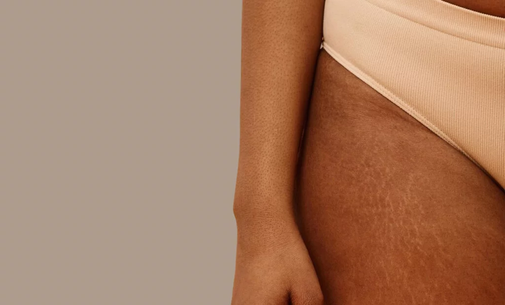 Is Laser Hair Removal Bad for Stretch Marks?