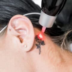 Picosure Tattoo removal mobile banner