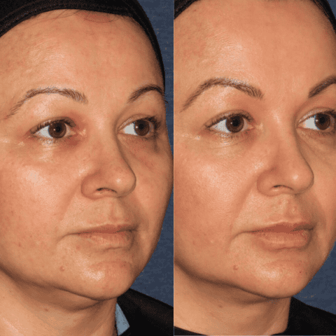ultherapy prime before and after