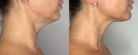sofwave before and after 4