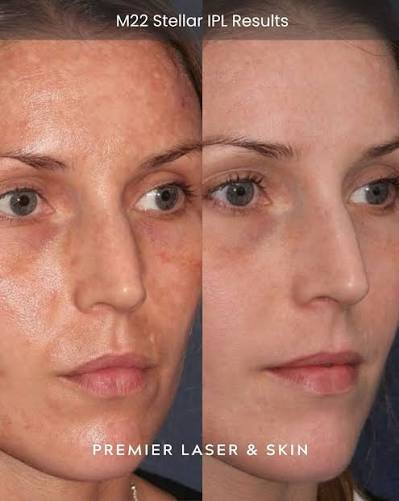Before and after