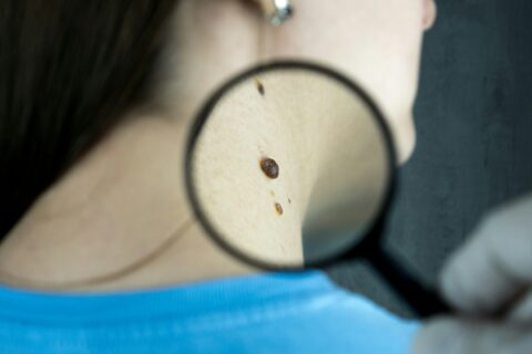 doctor checking skin mole on a female patient