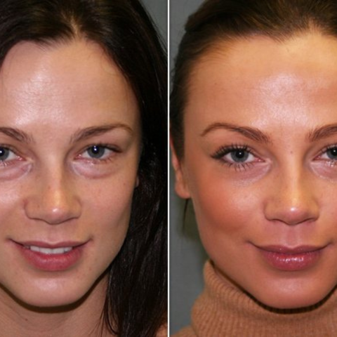 Skin before and after - PRP Treatment