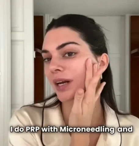 Kendall Jenner loving PRP + Microneedling Skin Treatments