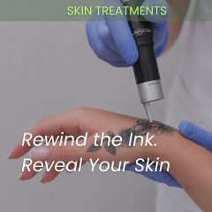 tattoo removal special offer