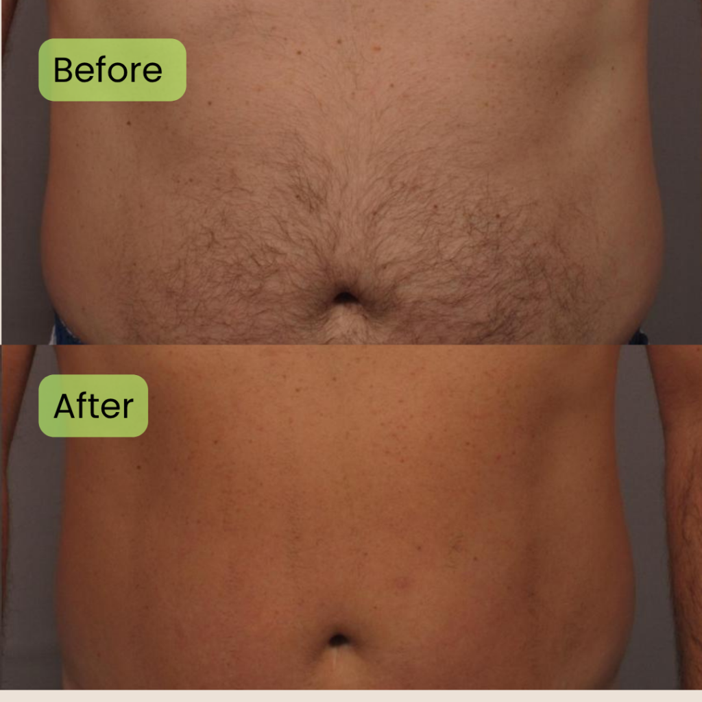 Before and after