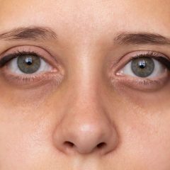 Polynucleotides VS Tear Trough filler: Which is better?