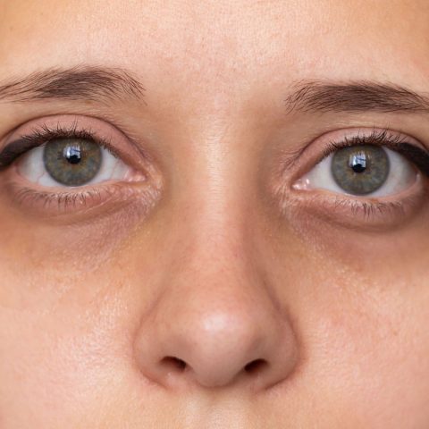 Polynucleotides VS Tear Trough filler: Which is better?