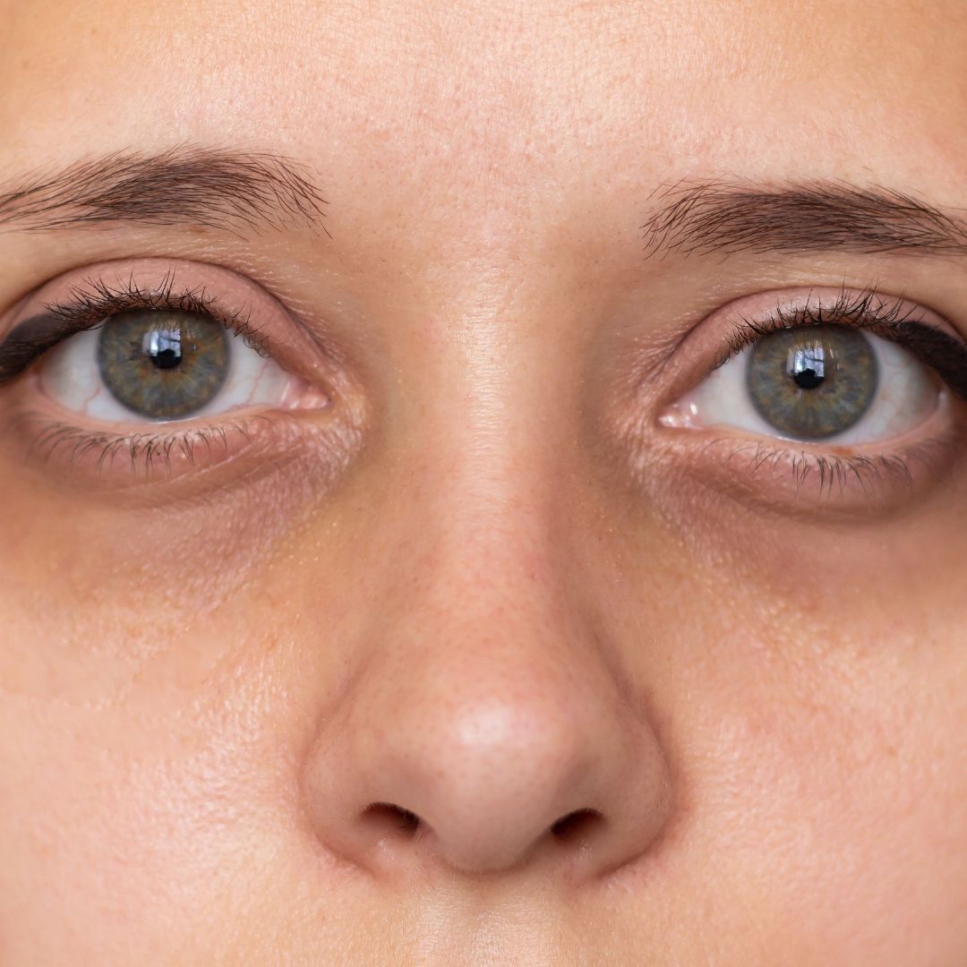 polynucleotides vs dermal filler