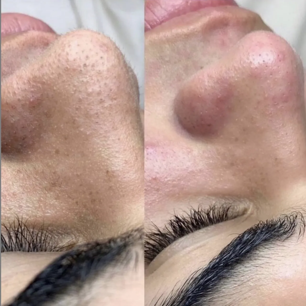 A side-by-side close-up shows a person's nose with congested skin and dark dots on the left, compared to noticeably clearer, smoother skin on the right.