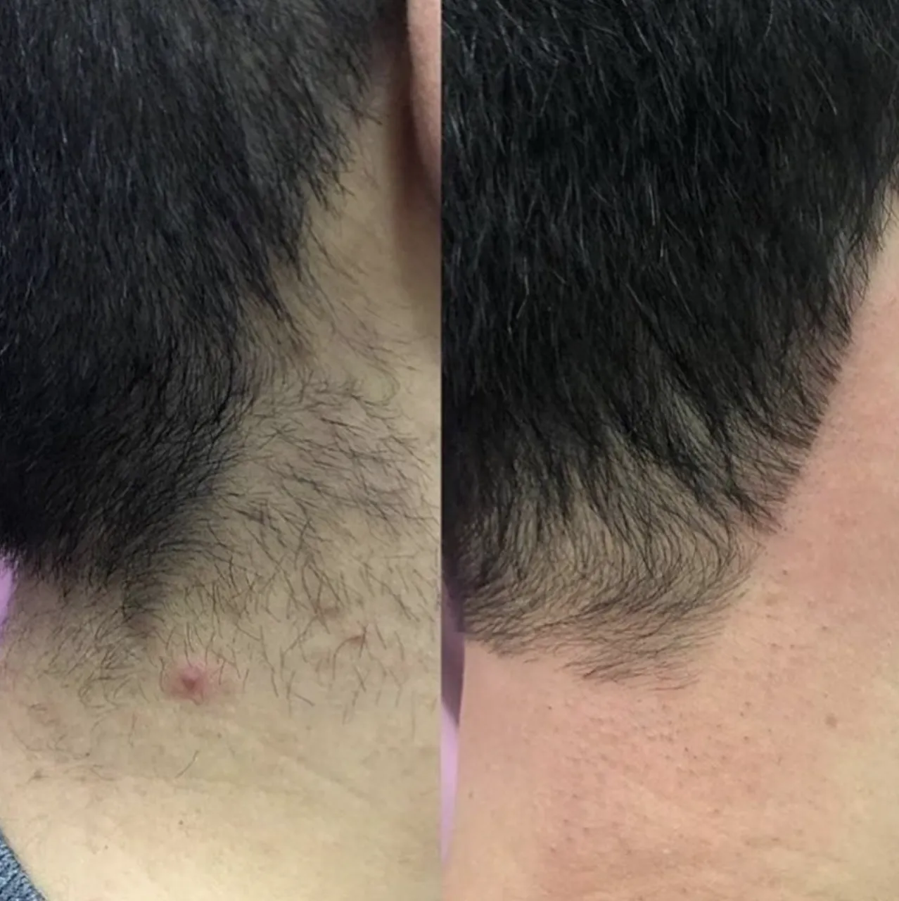 A side-by-side comparison shows a man's neck hairline with a red bump on the left, and a cleanly trimmed, smooth hairline on the right.