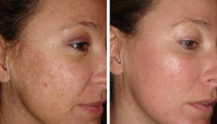 Before and after
