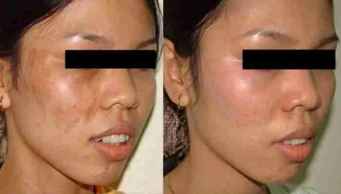 Before and after